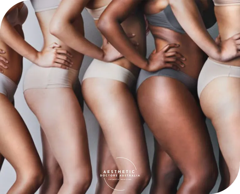 Subcision for cellulite at Aesthetic Doctors Australia, Kew Melbourne: image 1