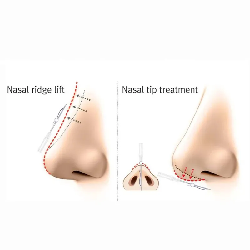 Non-surgical rhinoplasty at Aesthetic Doctors Australia, Kew Melbourne: image 2