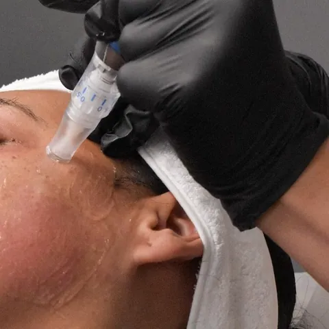 Microneedling at Aesthetic Doctors Australia, Kew Melbourne: image 1
