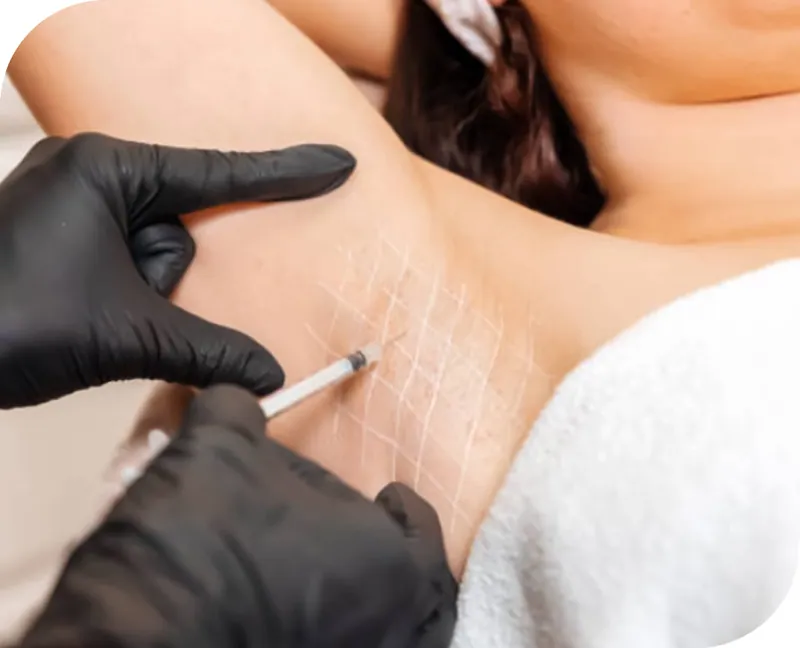Underarm treatment for excessive sweating in progress