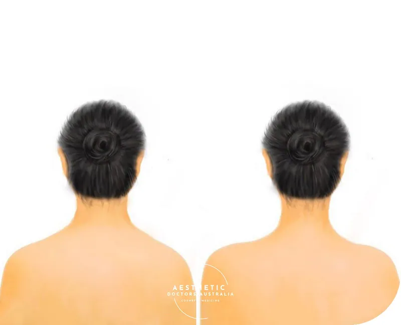 Trapezius slimming at Aesthetic Doctors Australia, Kew Melbourne: image 2