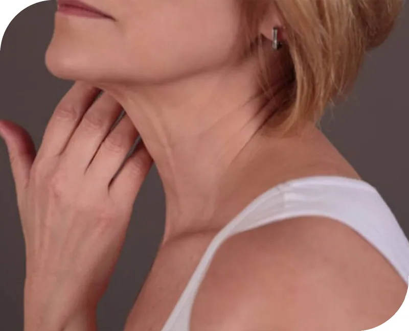 Neck rejuvenation at Aesthetic Doctors Australia, Kew Melbourne: image 1