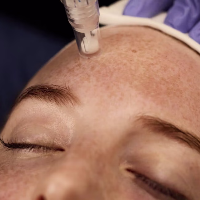 Microneedling at Aesthetic Doctors Australia, Kew Melbourne: image 2